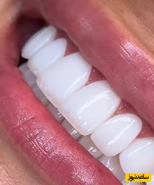 آیا دندان شکسته را می توان با کامپوزیت ترمیم کرد؟