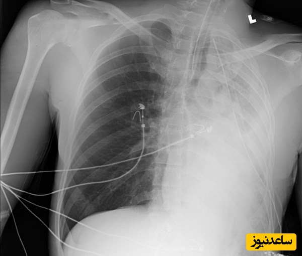 آب آوردن ریه