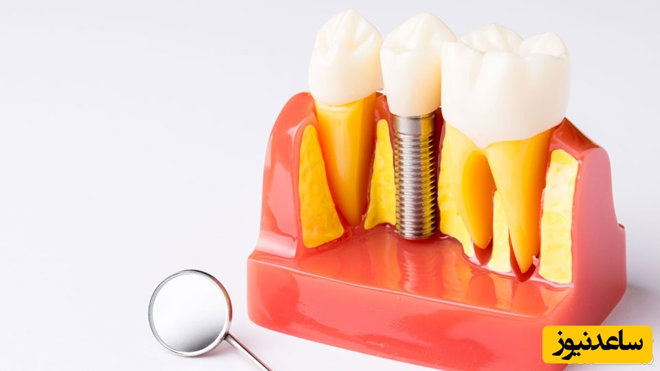 عوارض جانبی استفاده از ایمپلنت نامرغوب چیست؟