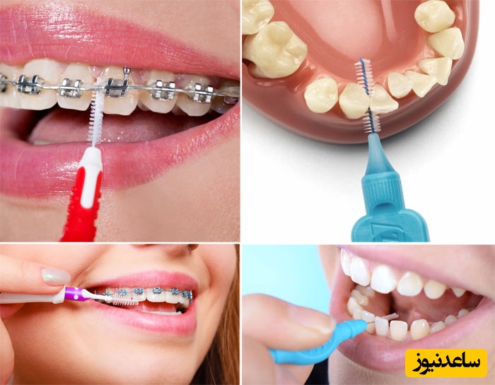 روش درست مسواک زدن حین ارتودنسی ثابت