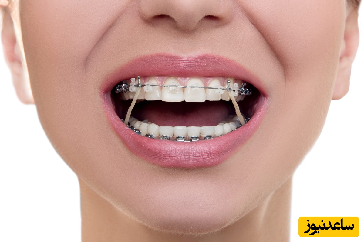 دندان گرازی چیست؟