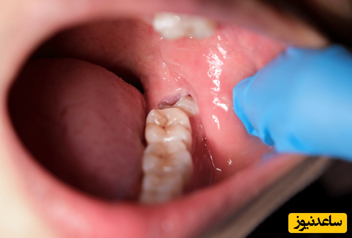 بعد از کشیدن دندان عقل چه غذاهایی بخوریم؟