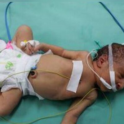 (ویدئو) وضعیت تلخ نوزادان نارس در بیمارستان شفا غزه