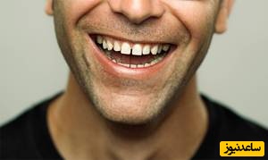 بستن فاصله بین دندان ها به 3 روش