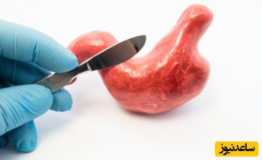 فواید و مضرات عمل بای پس معده چیست؟ نکاتی که باید بدانید