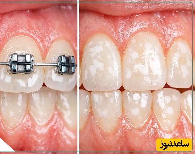 لکه های سفید دندان پس از ارتودنسی را چگونه از بین ببریم؟
