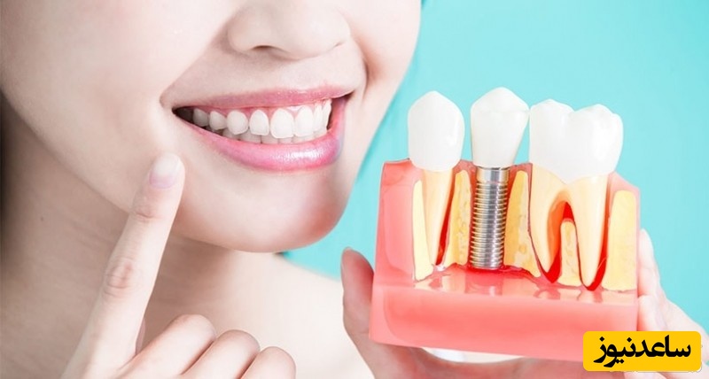 عوارض احتمالی ایمپلنت چیست؟