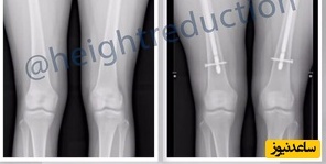  جراحی کوتاهی قد