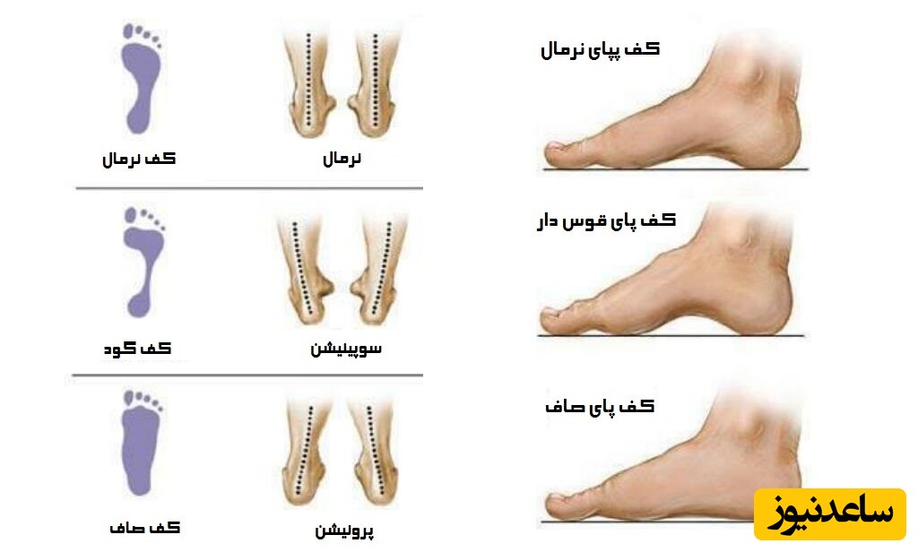 کفش مناسب برای پاهای پنجه دار