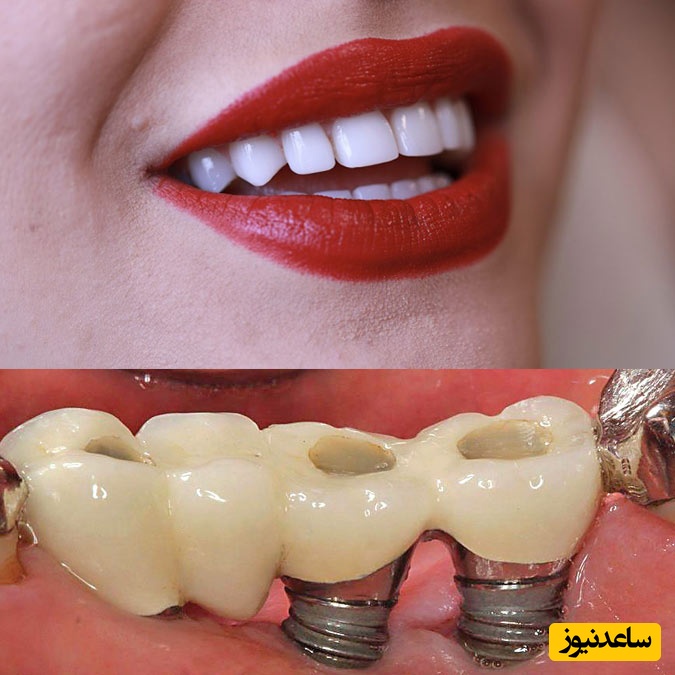 چرا از روکش دندان استفاده می شود؟