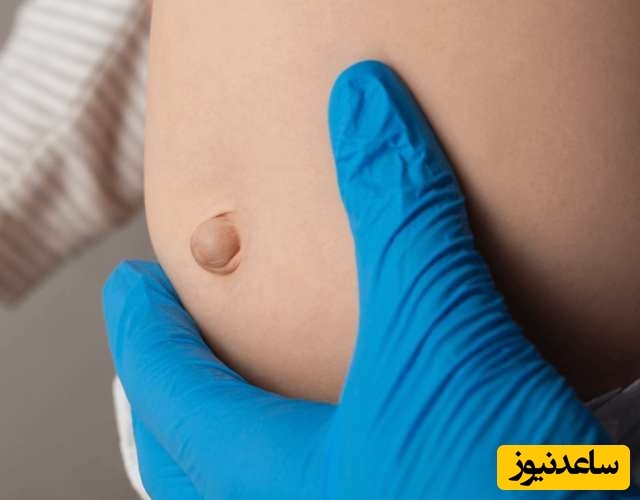 دلایل فتق نافی در کودکان و روش های درمان آن چیست؟