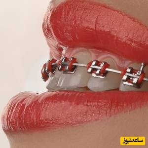 براکت هم رنگ دندان چیست؟