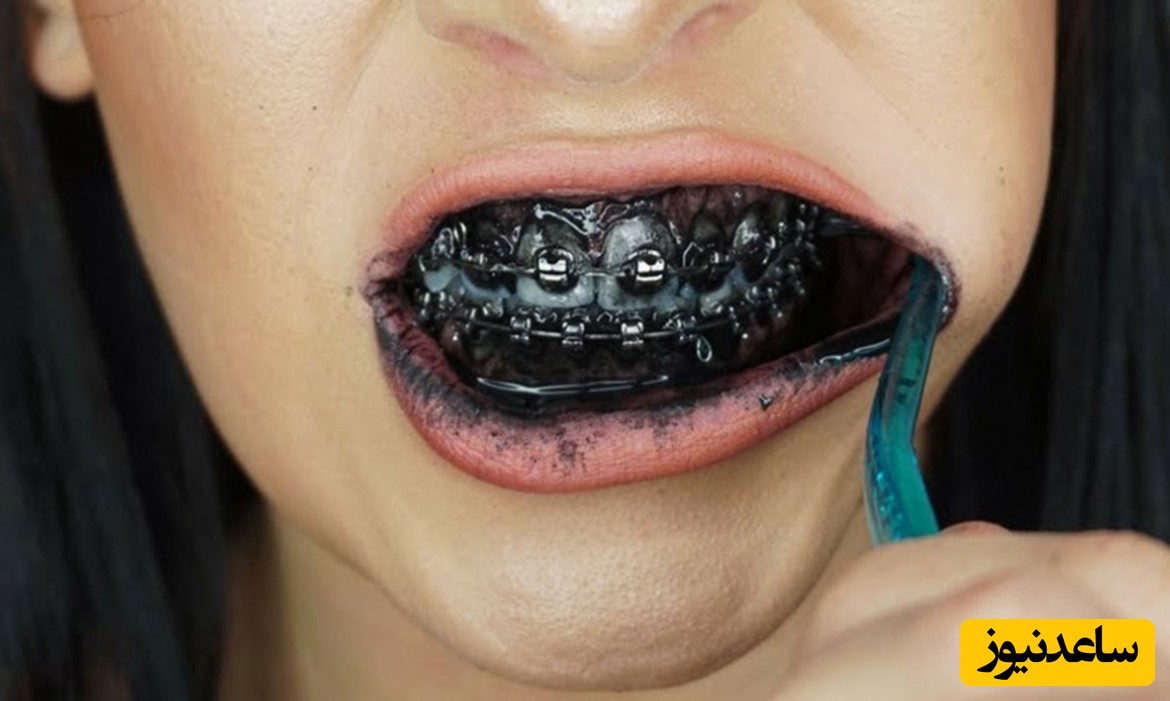 آیا خمیردندان حاوی زغال فعال می تواند اثری بر روی سفیدی دندان داشته باشد؟