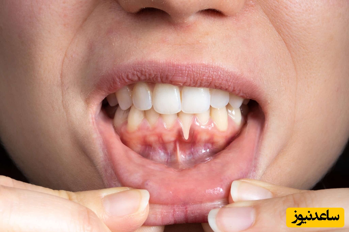 راه‌های پیشگیری از عقب رفتگی لثه