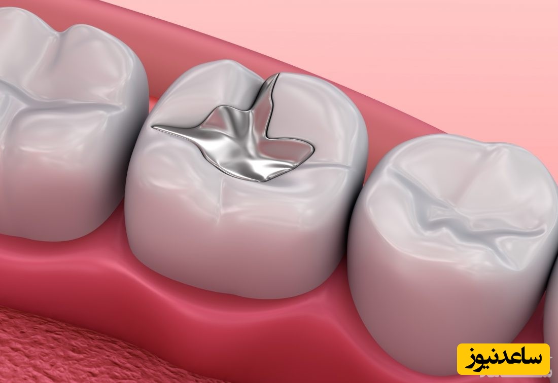 عوارض و مشکلات پر کردن دندان که باید بدانید!