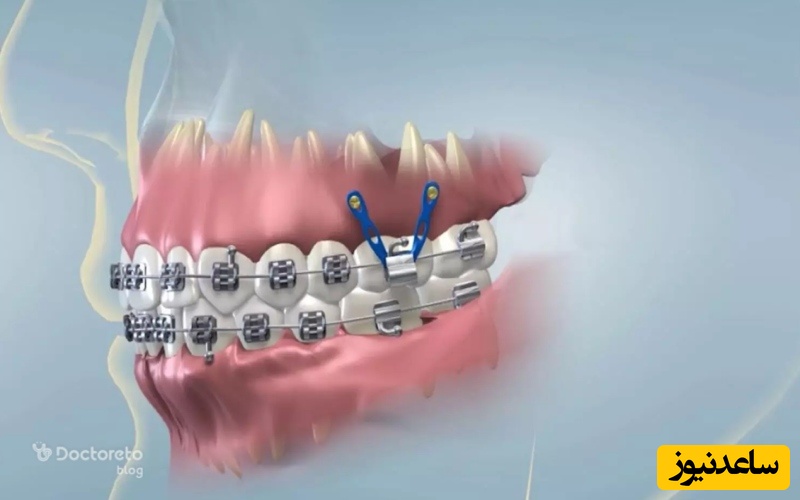 نقش مینی اسکرو ها در ارتودنسی چیست؟