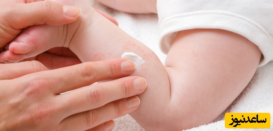  کهیر زدن نوزاد