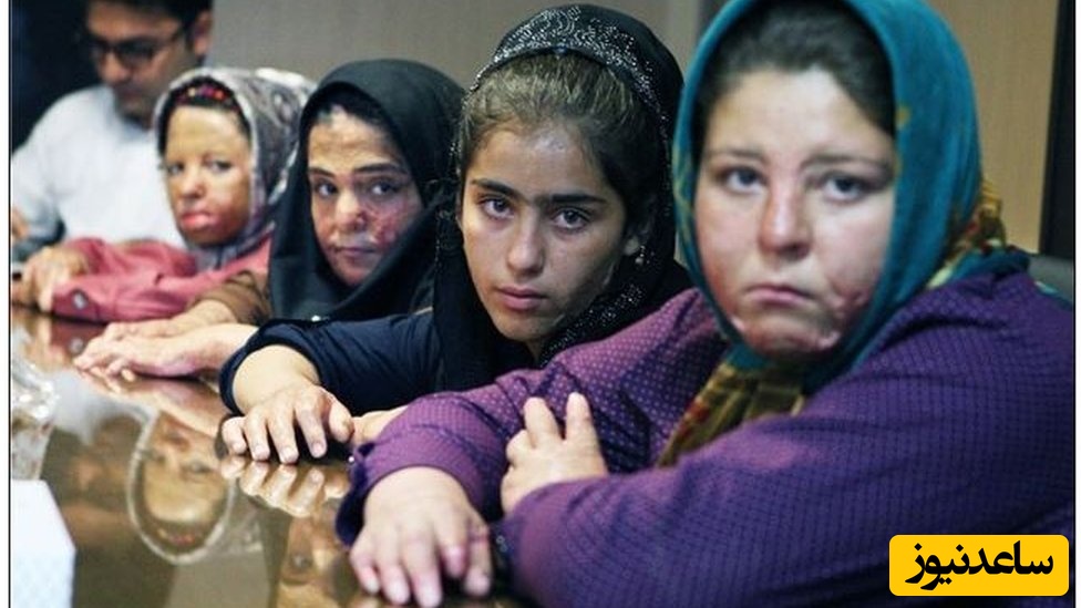 تصاویر دلخراش دختران شین‌آبادی بعد از 13 سال / هزینه های درمان سنگین است، وعده‌ها فراموش شدند / بخاری نفتی که زندگی 29 دختر را از بین برد