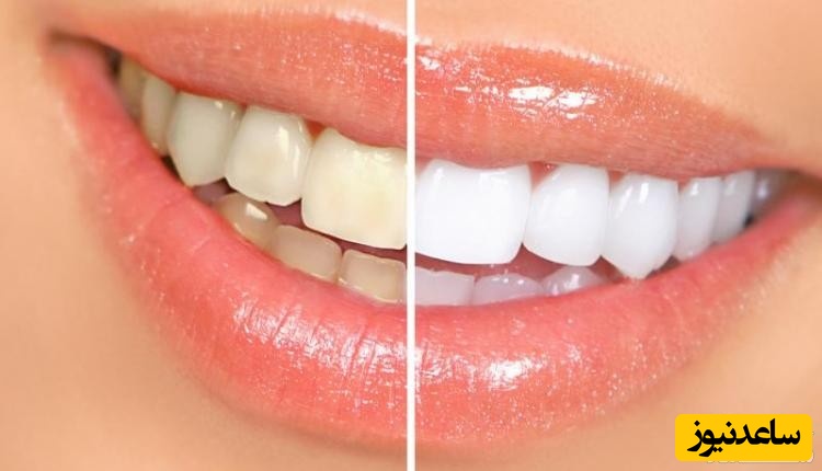 مزایا و معایب بلیچینگ دندان