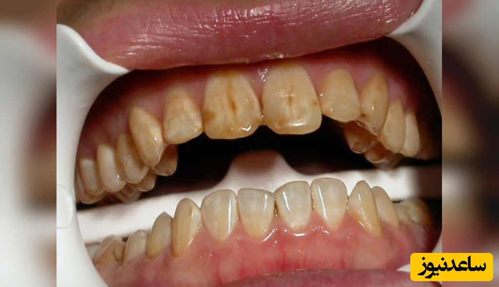 علت ایجاد لکه ی قهوه ای بر روی دندان