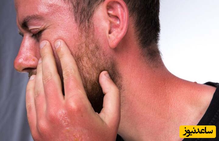 10 روغن گیاهی فوق العاده برای درمان آفتاب سوختگی که باید بشناسید