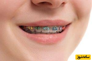 چرا ارتودنسی در سنین پایین‌تر بهتر است؟