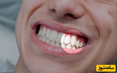 گزینه‌های درمانی برای دندان ترک خورده چیست؟