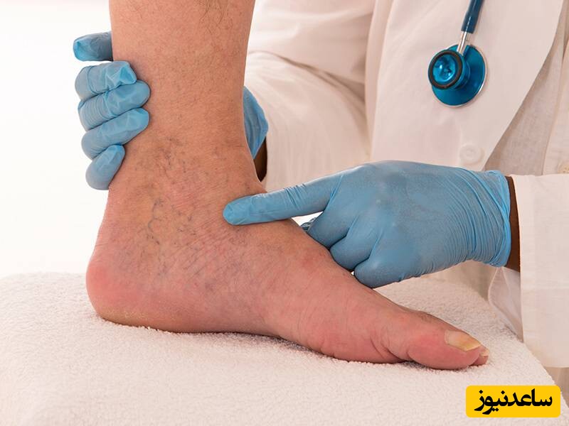 مزایای مراجعه به بهترین دکتر برای درمان واریس