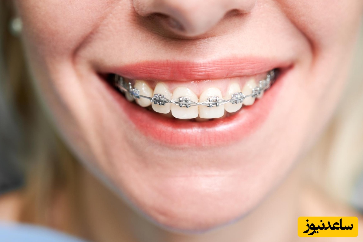 انواع مختلف ارتودنسی و بهترین نوع آن