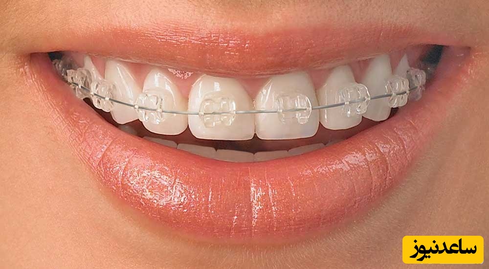 حرکت دندان با دستگاه ارتودنسی متحرک چگونه اتفاق می افتد؟