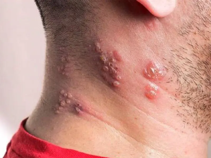 آنچه بیماران مبتلا به تبخال و زونا باید درباره والاسیکلوویر بدانند