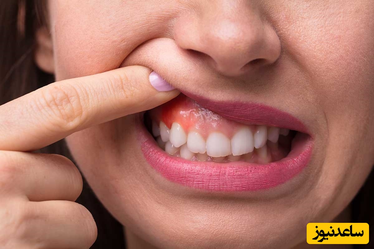 تومور حاملگی یا تومور لثه (تورم لثه)