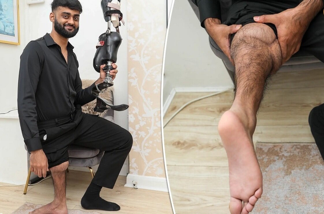 مدل عجیب راه رفتن بیمار سرطانی با پای برعکس شده +ویدئو