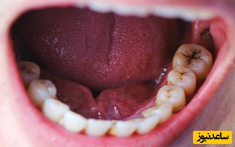 استحکام آمالگام برای پر کردن دندان بیشتر است یا کامپوزیت؟