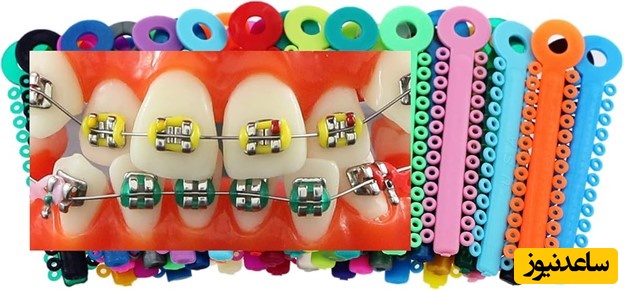 چگونه بهترین رنگ را در ارتودنسی رنگی انتخاب کنیم؟