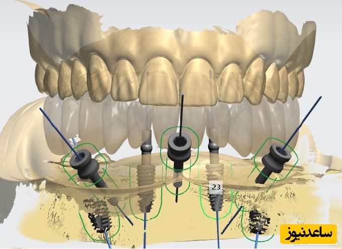 مزایا و معایب دندان مصنوعی فلیپر