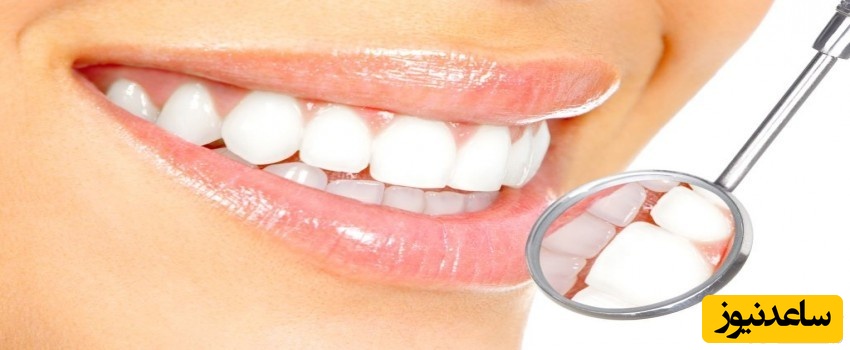 همه چیز درباه ی لمینیت دندان