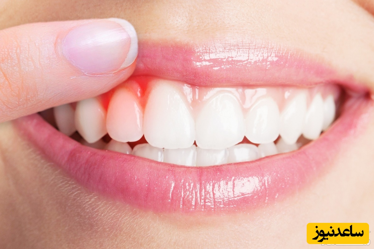 سوالات متداول در مورد عفونت لثه