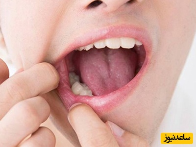 سوالات متداول و رایج درباره ی کیست دندان