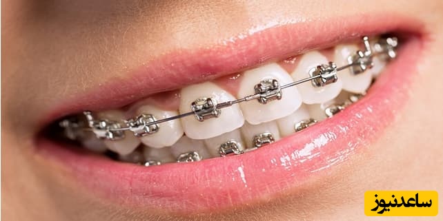 بهترین نوع ارتودنسی ثابت چیست؟