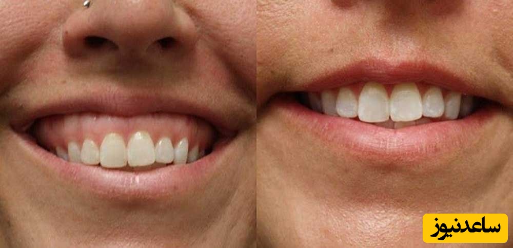 لبخند لثه ای چیست و دلایل آن