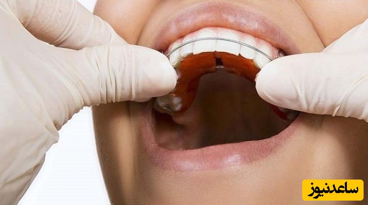 طرز کار ارتودنسی متحرک چگونه است؟