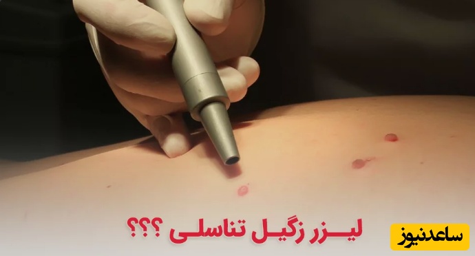 چرا لیزر روشی مناسب برای حذف زگیل تناسلی در کلینیک است؟