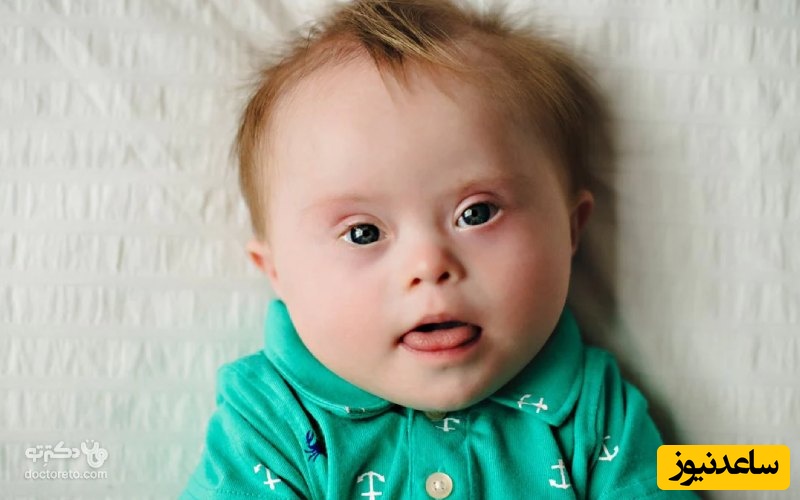 سندروم داون