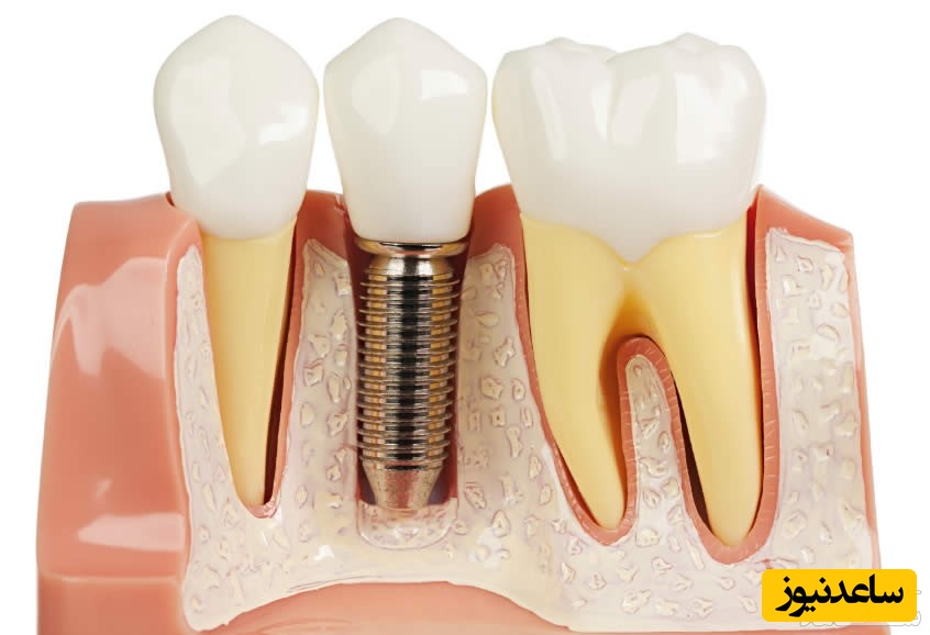تفاوت بین مینی ایمپلنت و ایمپلنت معمولی دندان 