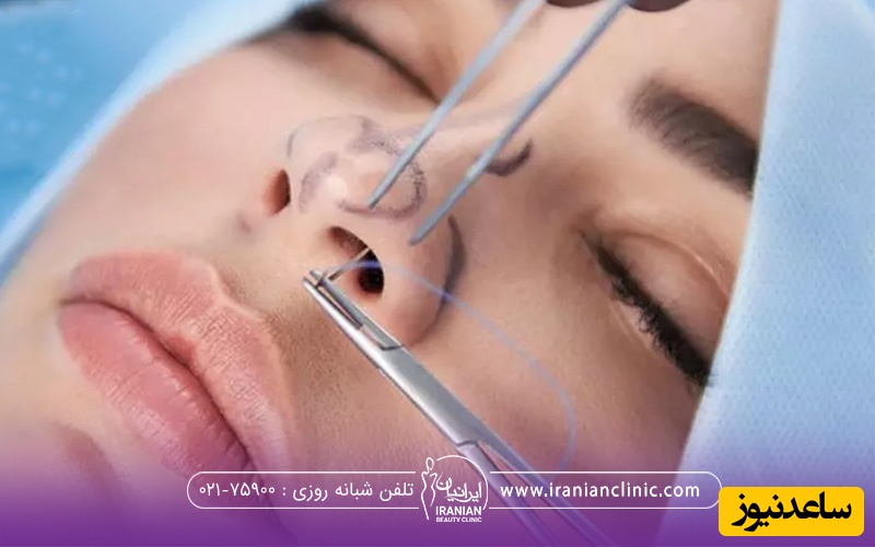 تا چند روز بعد عمل بینی باید سربالا باشد؟