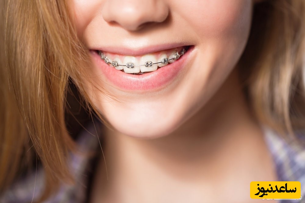 تاثیر ارتودنسی بر بینی چگونه است؟