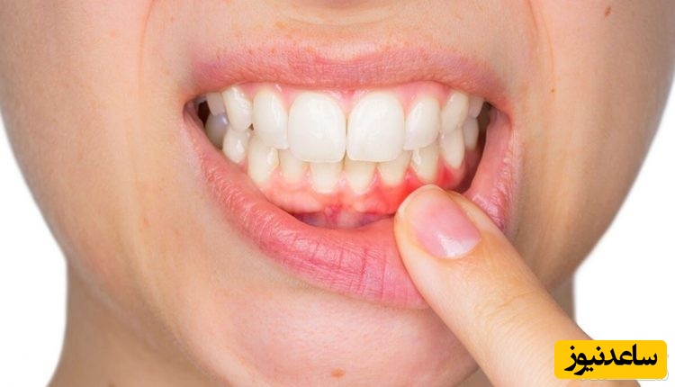 درمان عفونت ریشه دندان و لثه