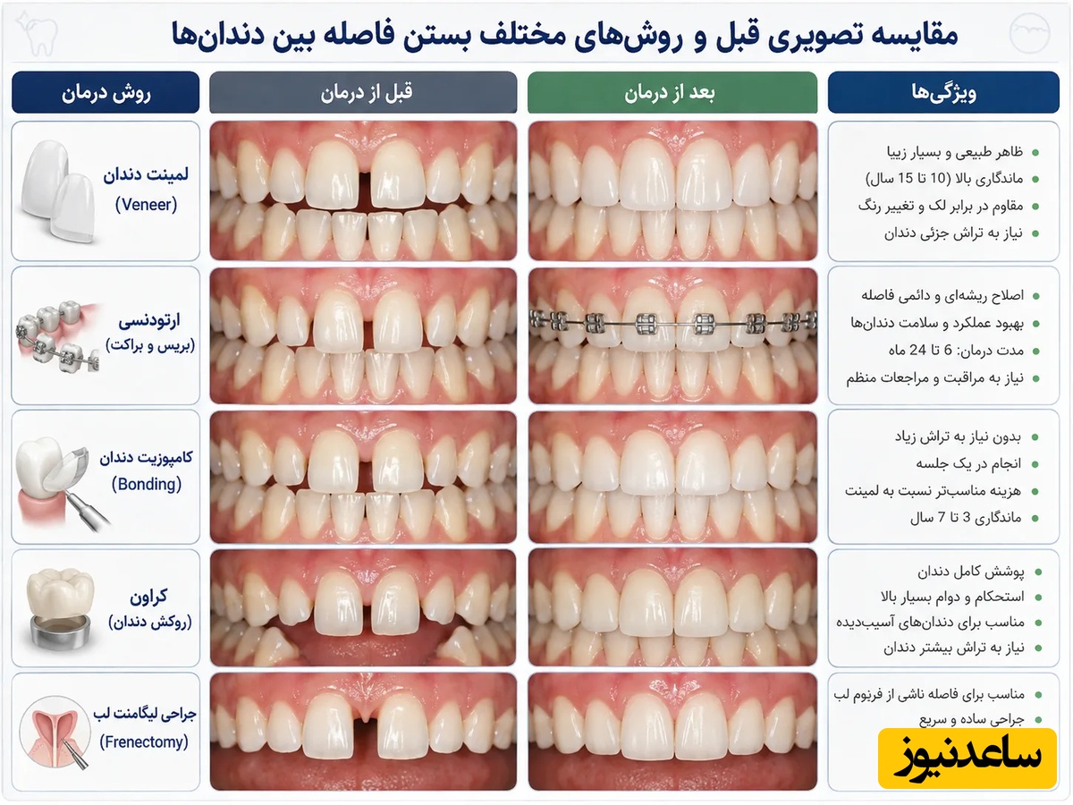مقایسه قبل و بعد از بستن فاصله بین دندان