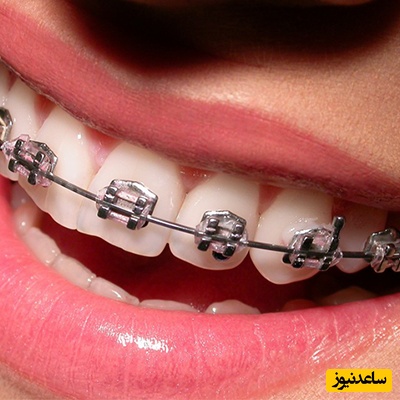 خصوصیات دستگاههای ارتودنسی و انواع آن